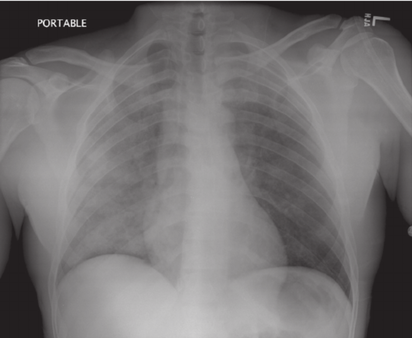 Chest-X-ray-showing-bilateral-infiltrates-right-greater-than-left-suggestive-of.png