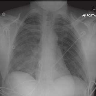 Chest-X-ray-taken-on-2-nd-day-of-admission-in-the_Q320.jpg