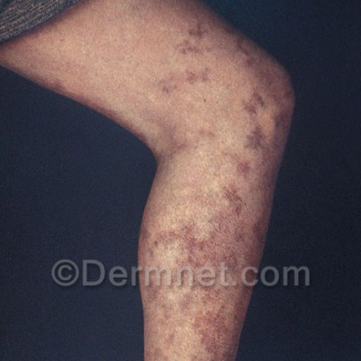 vasculitis-004.jpg