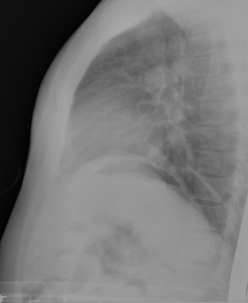 CXR194_IM-0609-1001.png