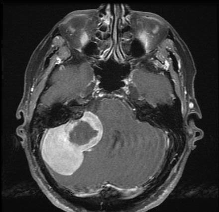 meningioma.jpg