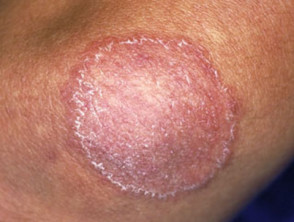 tinea-body-137.jpg